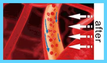 IWA-RLT40 — illustration of improved local circulation after IWA-RLT40 — illustration of improved local circulation after red light therapy